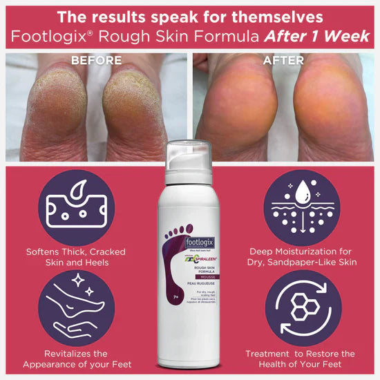 Footlogix Rough Skin Formula 125ml