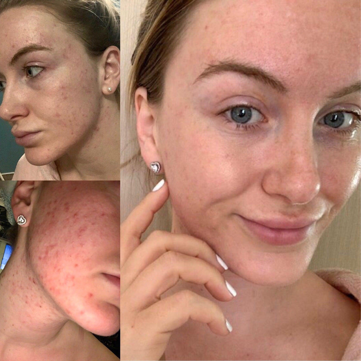 Douvall's Argan Acne Rehab Serum 30ml | Plant-Based Formula for Acne-Prone Skin